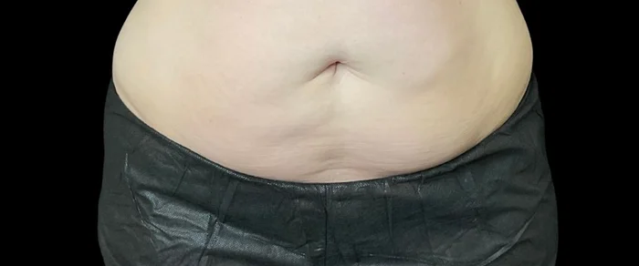 Abdomen before CoolSculpting