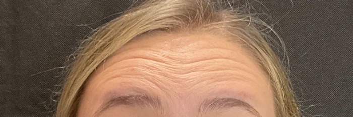 Forehead lines before Dysport