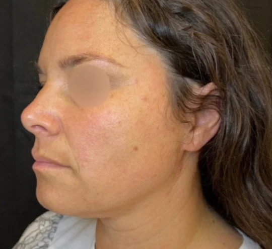 Profile before facial balancing