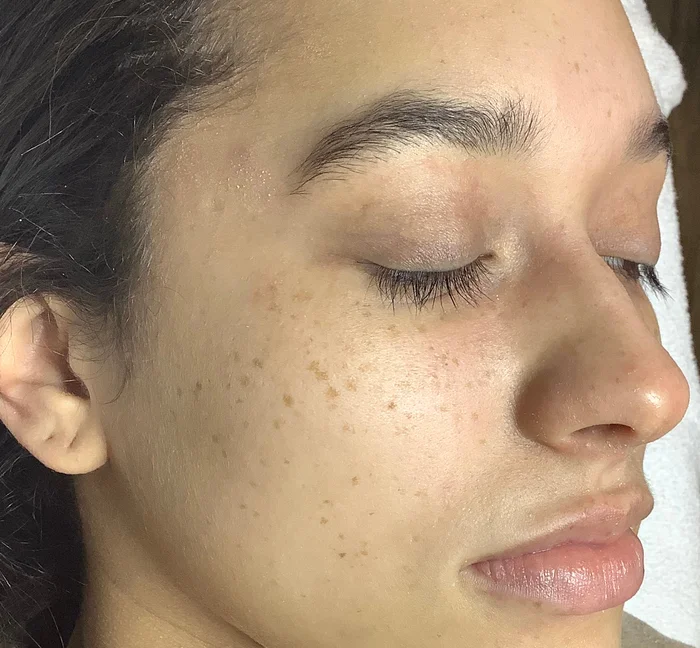 Lips before enhancement
