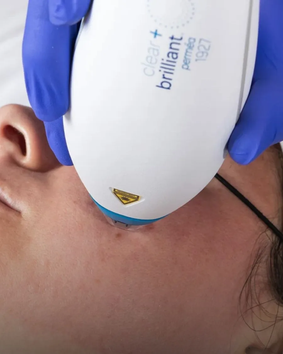 Clear + Brilliant at Back to 30 Med Spa