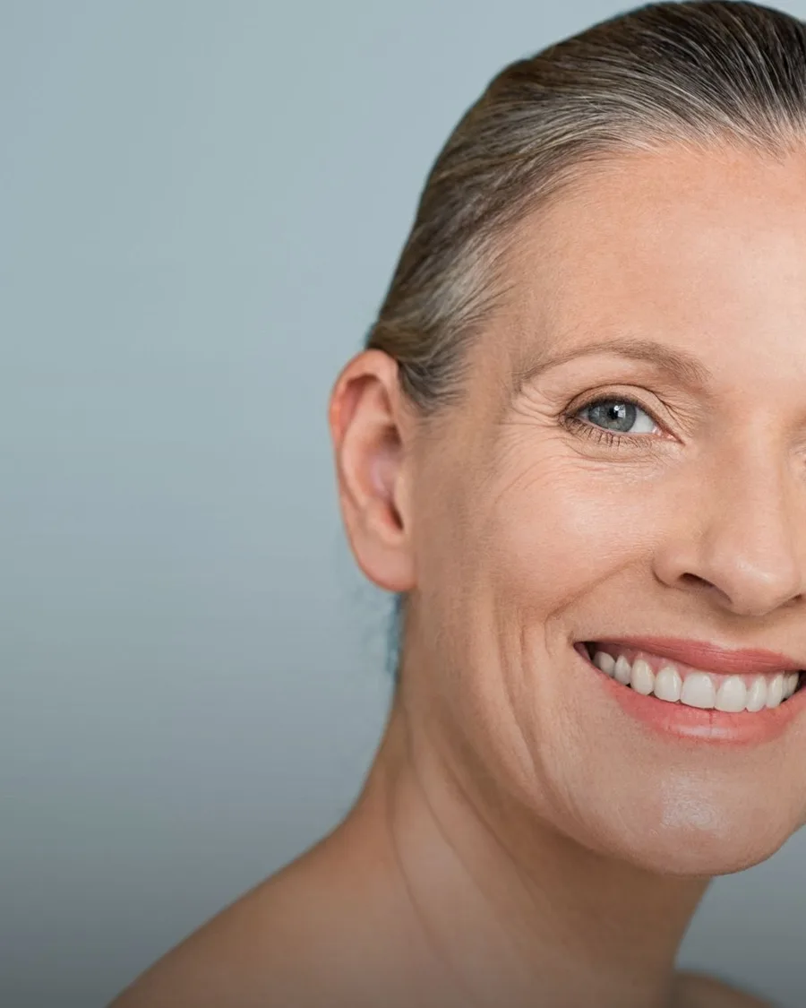 Hyper Dilute Radiesse at Back to 30 Med Spa