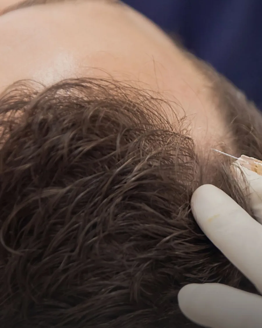 Hair Restoration at Back to 30 Med Spa