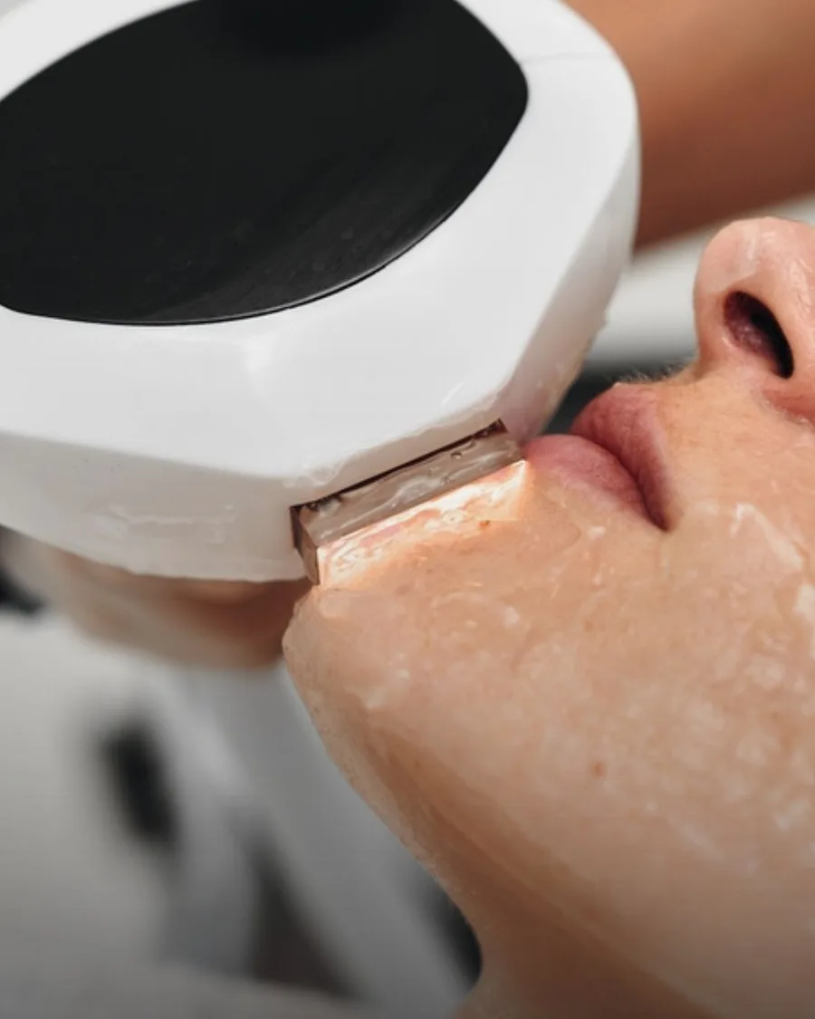 IPL Photofacial at Back to 30 Med Spa