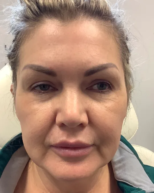 Microneedling