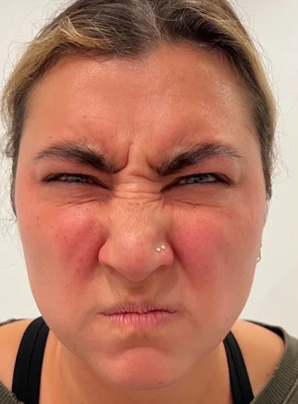 Frown lines before Botox
