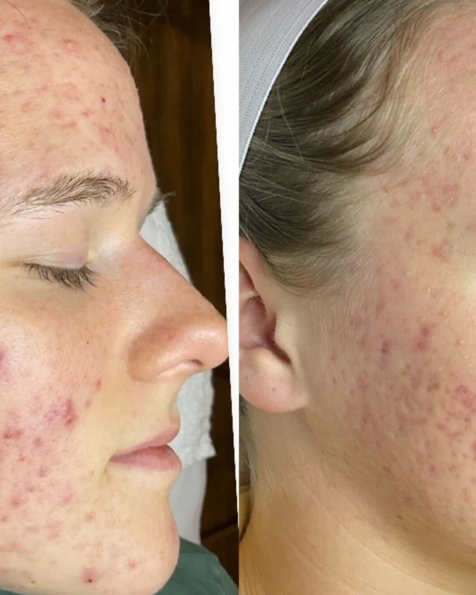 Back to 30 treatment results