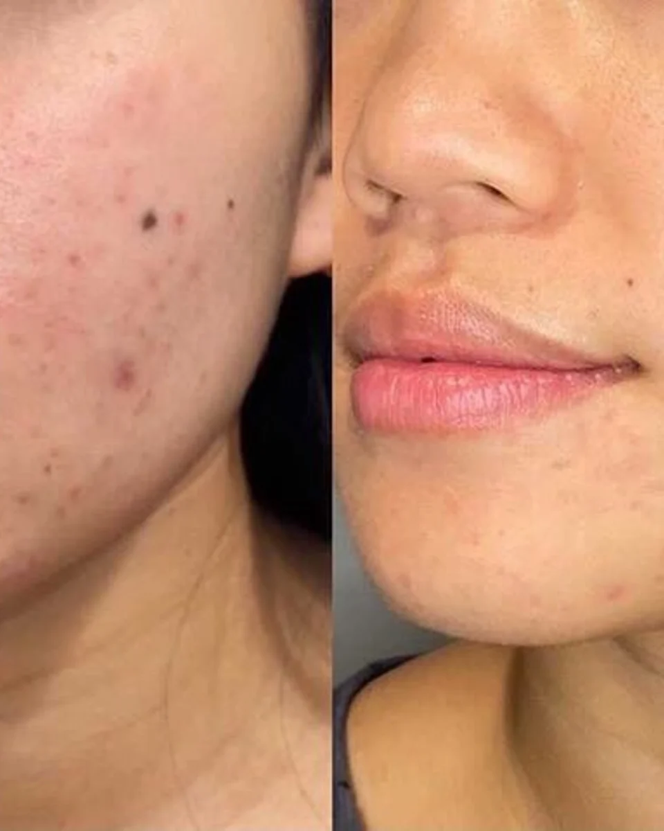 Back to 30 treatment results