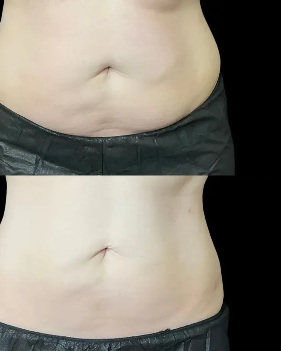 Back to 30 treatment results