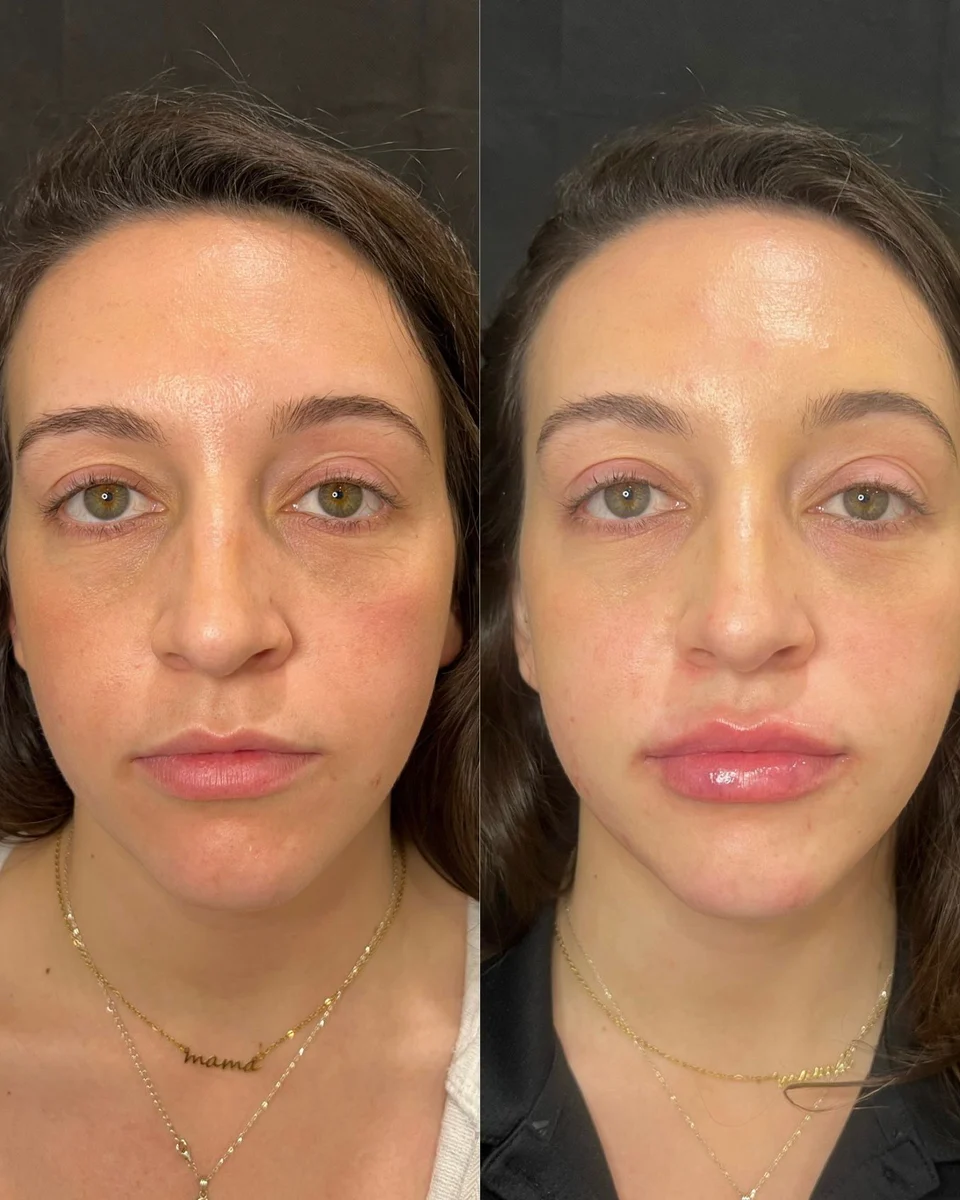 Back to 30 treatment results