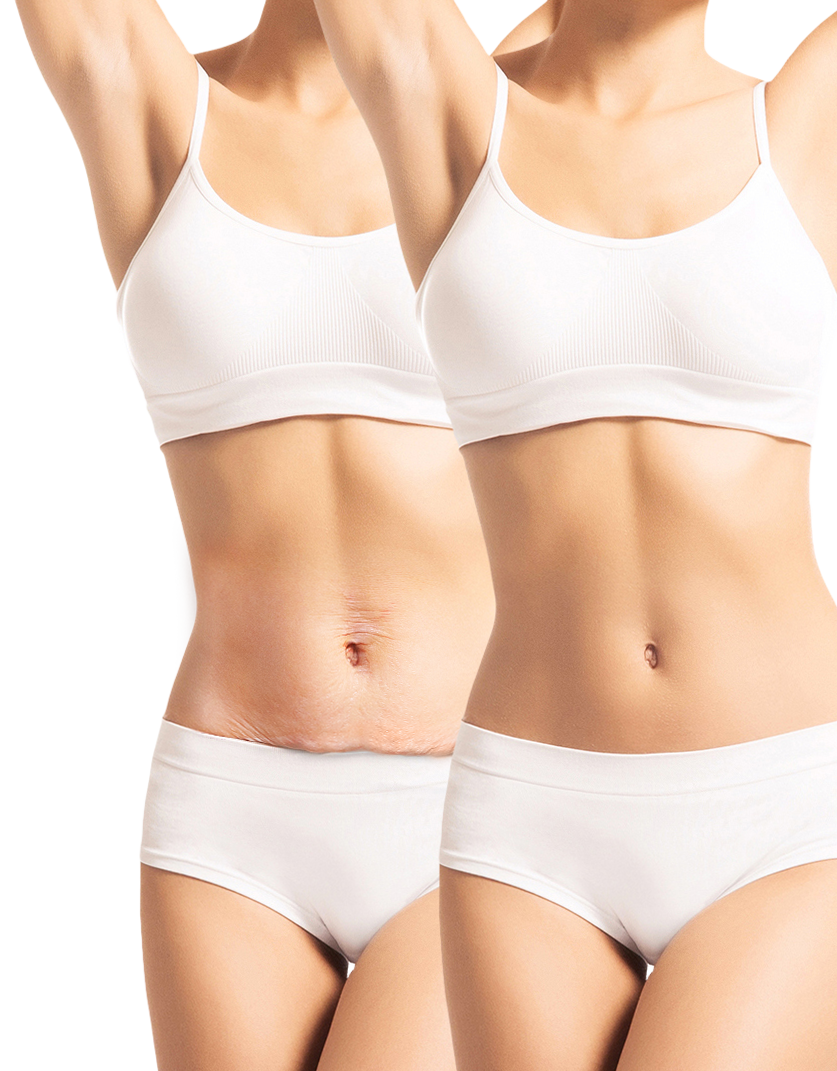 extended tummy tuck recovery time