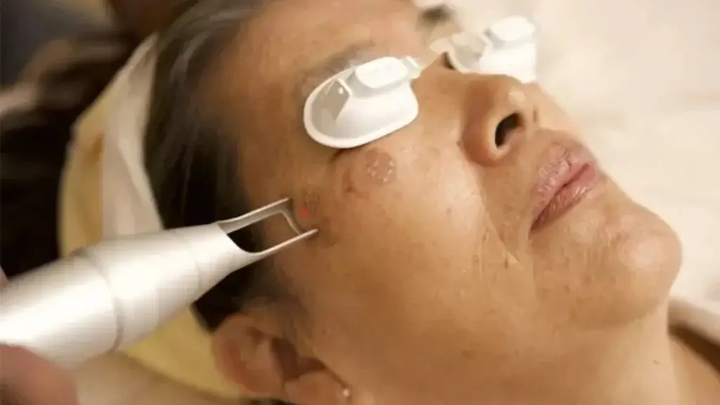 Erbium Laser Resurfacing For Face
