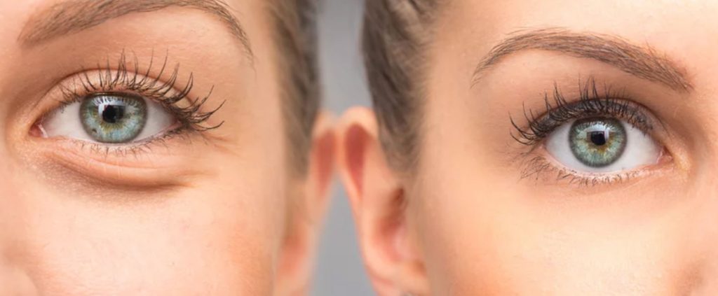 PRF Before and After