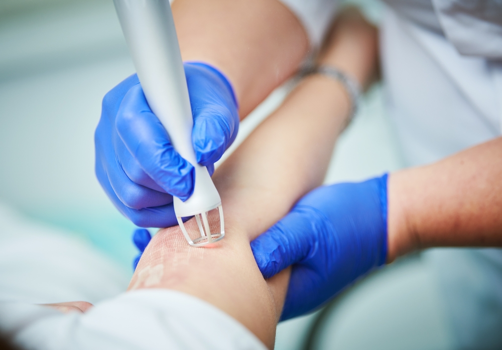 co2 laser resurfacing in south carolina