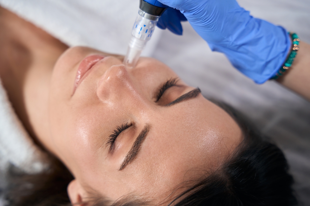 Microneedling treatments