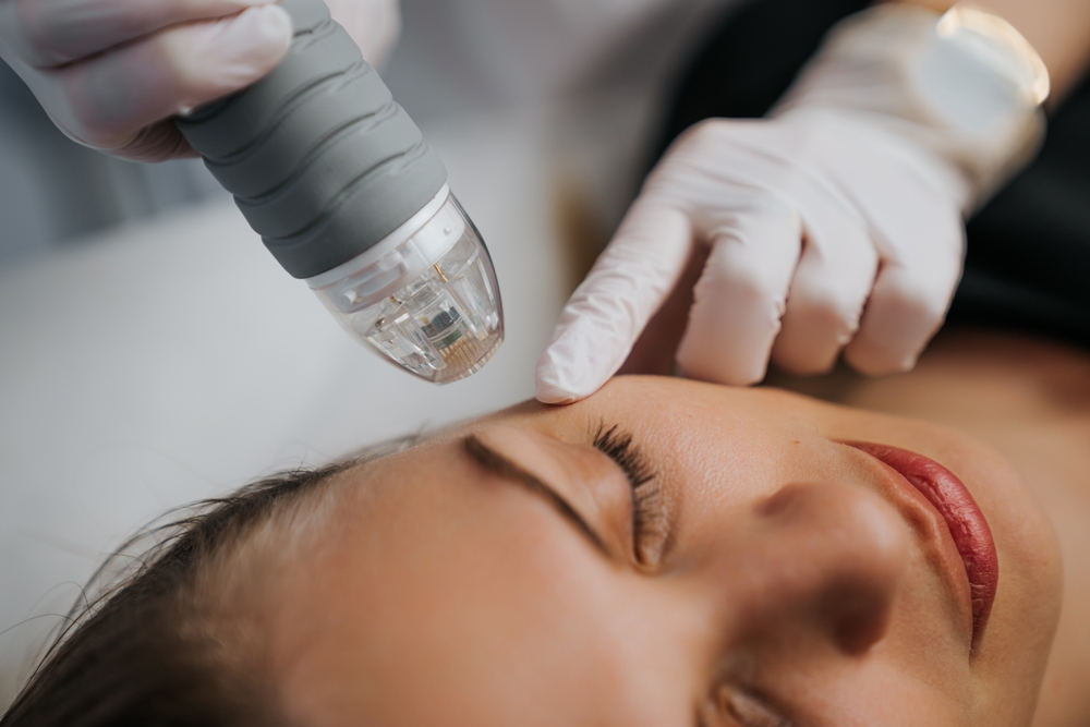 microneedling with exosomes