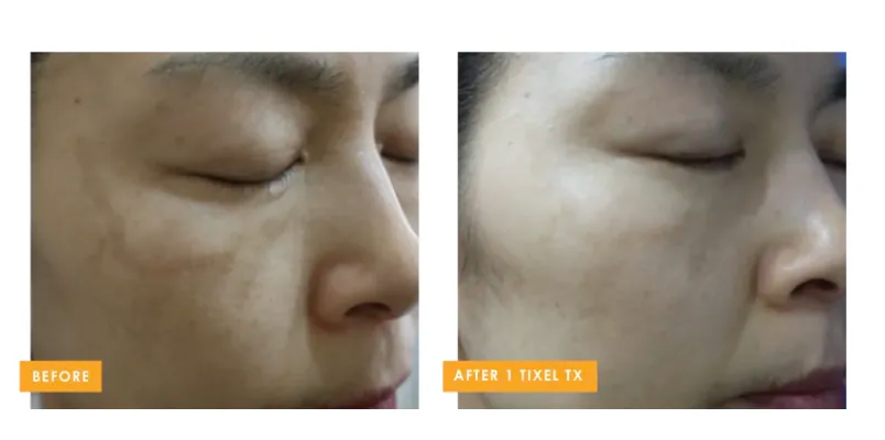 Tixel 2® fractional skin rejuvenation before and after improving uneven skin tone and texture at Back to 30 in South Carolina